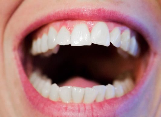 Gingivitis and Bleeding Gums - Top 5 Effective Remedies